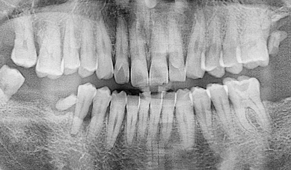 X-RAY 치료 전
