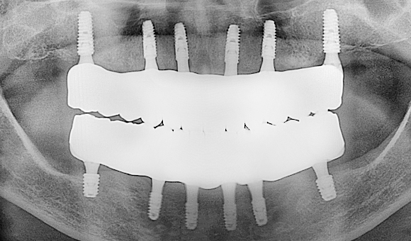 X-RAY 치료 후