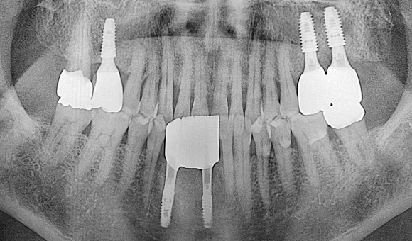 X-RAY 치료 후