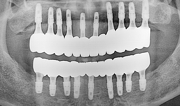 X-RAY 치료 후