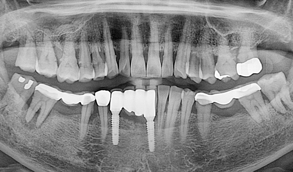 X-RAY 치료 전