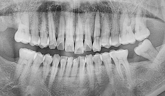 X-RAY 치료 전