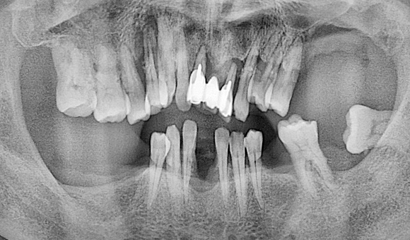 X-RAY 치료 전