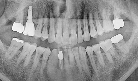 X-RAY 치료 전