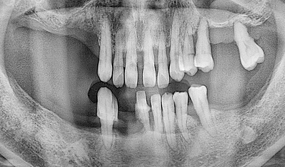 X-RAY 치료 전