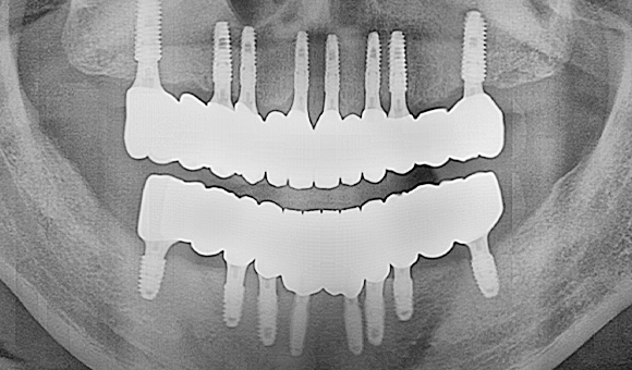 X-RAY 치료 후