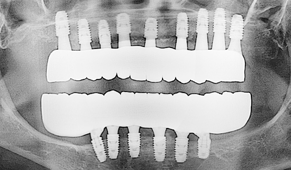 X-RAY 치료 후