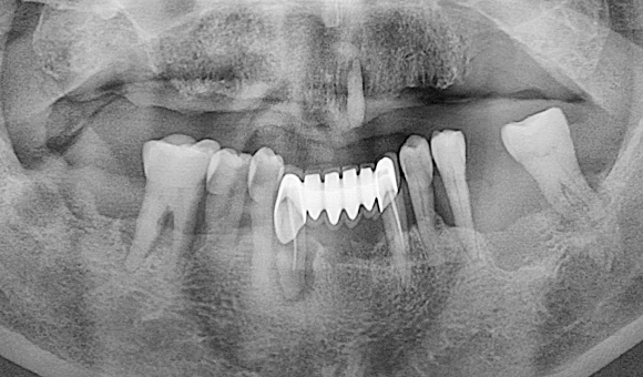 X-RAY 치료 전
