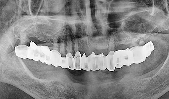 X-RAY 치료 전
