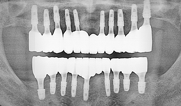 X-RAY 치료 후