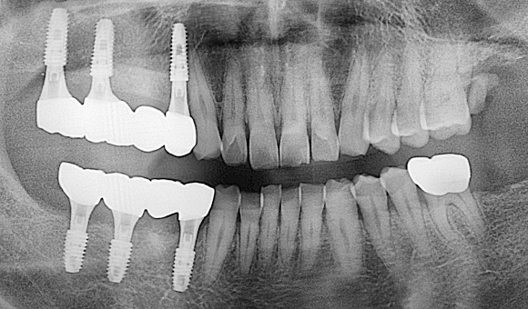 X-RAY 치료 후