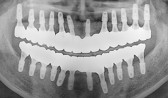 X-RAY 치료 후