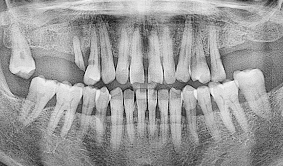 X-RAY 치료 전