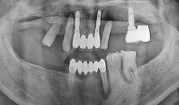 X-RAY 치료 전