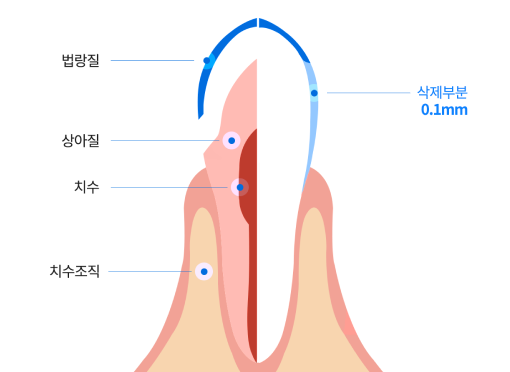 치아 최소 삭제 범위